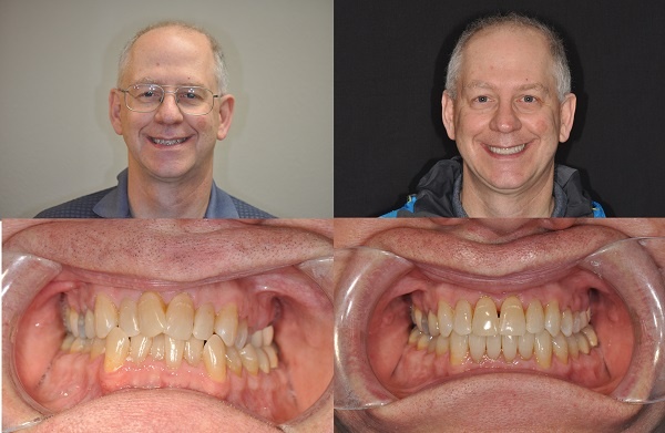 Gus-before-after-Invisalign
