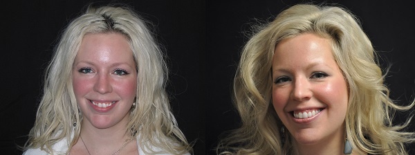 Jamie-before-after-Invisalign